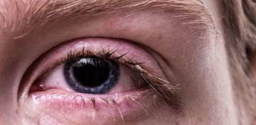 Ekranın uzun müddət istifadəsi gözlərdə allergik simptomları artırır
