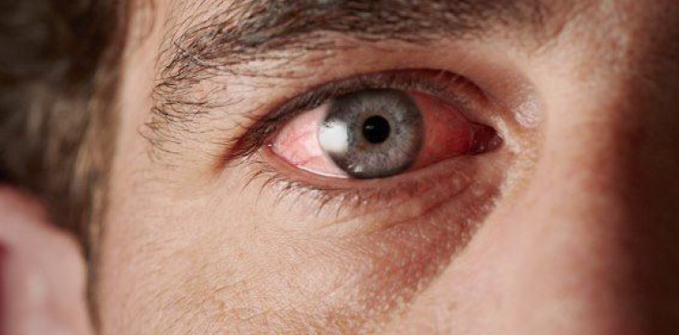 Göz zədələnməsinə səbəb olan allergik xəstəliklərin SƏBƏBİ açıqlandı